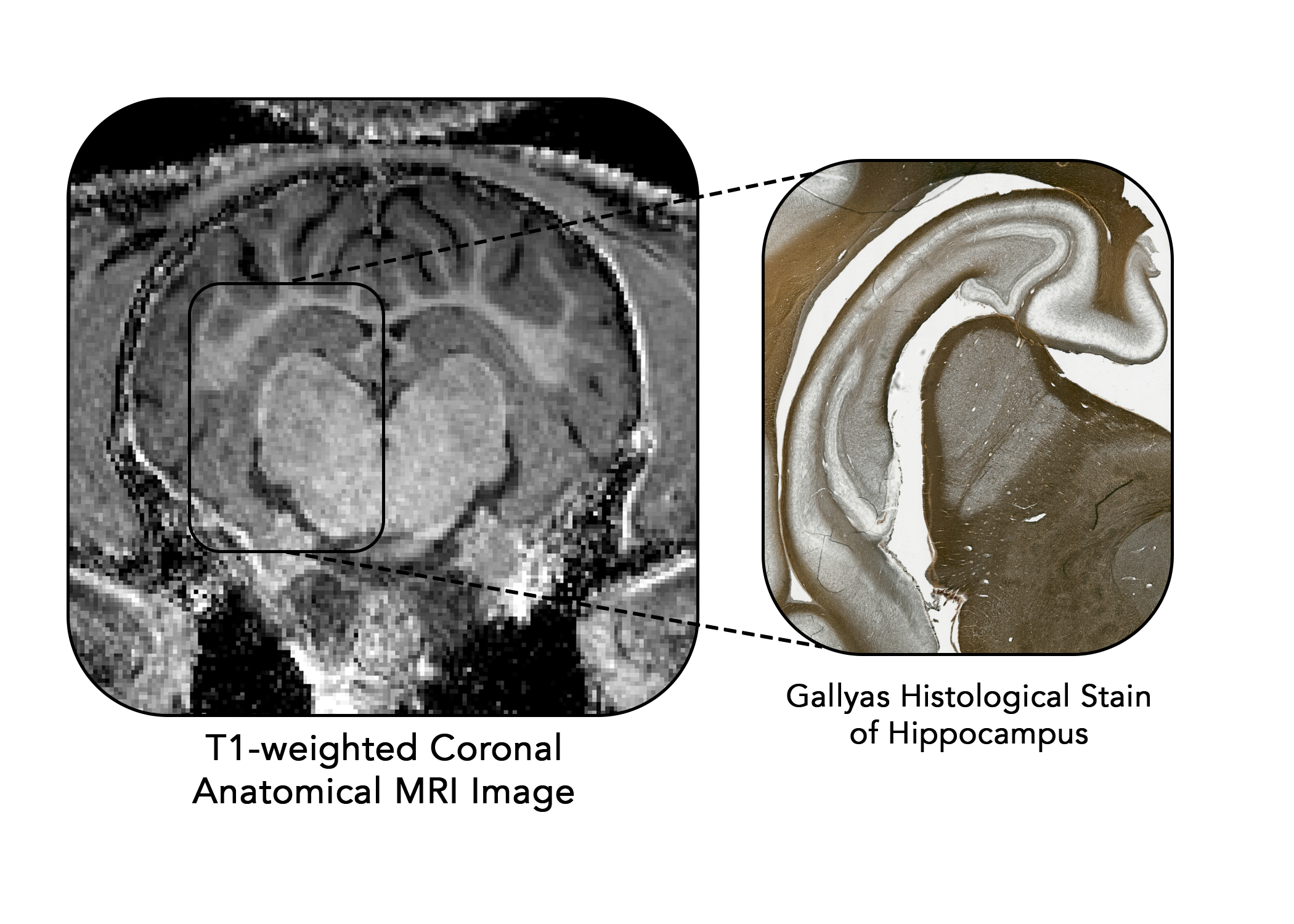 11-weighted coronal anatomical mri and gallyas histological stain of hippocampus